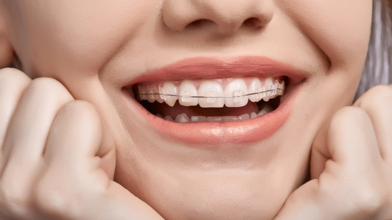 Best Orthodontic Care, San Carlos