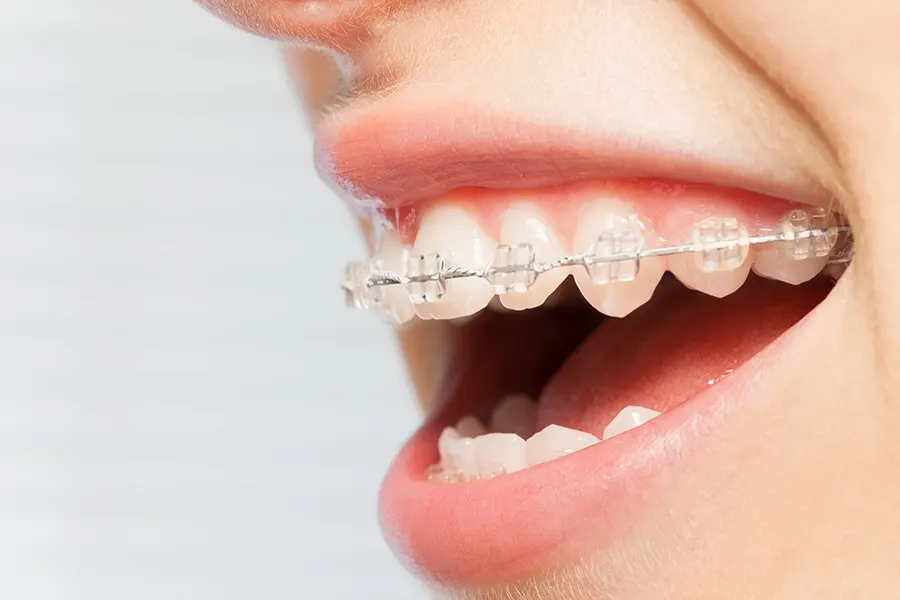 Closeup of clear ceramic braces on teeth