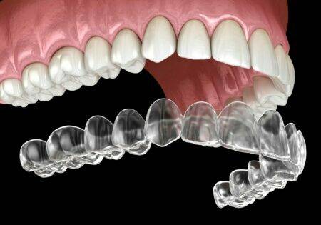 Invisalign for teens